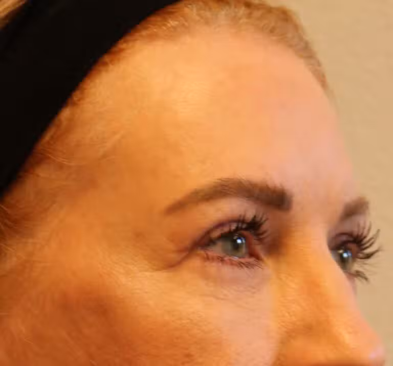 After Image: Upper Blepharoplasties – Fort Worth - right-front-oblique