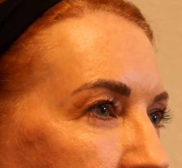 Before Image: Upper Blepharoplasties – Fort Worth - right-front-oblique