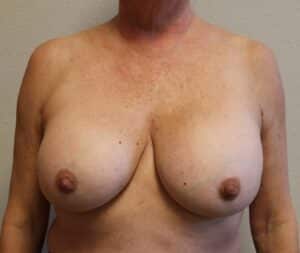 Before Image: Breast Revision – Fort Worth