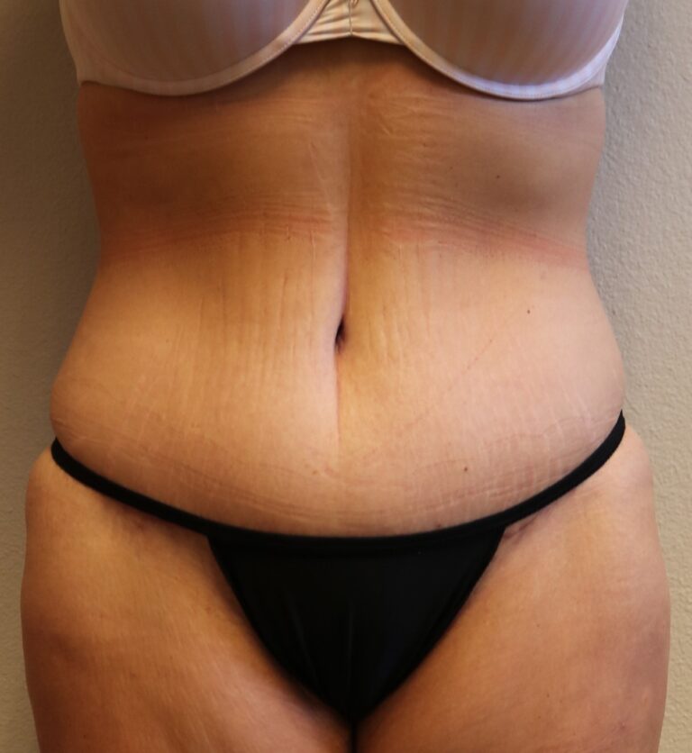 After Image: Tummy Tuck – Fort Worth - front
