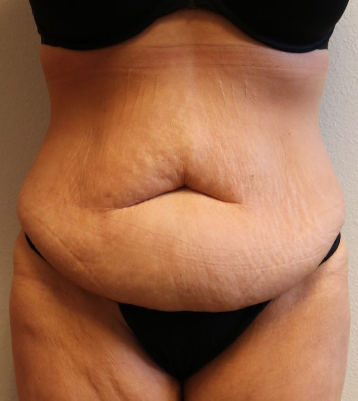 Before Image: Tummy Tuck – Fort Worth - front