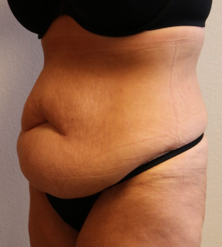 Before Image: Tummy Tuck – Fort Worth - left-front-oblique