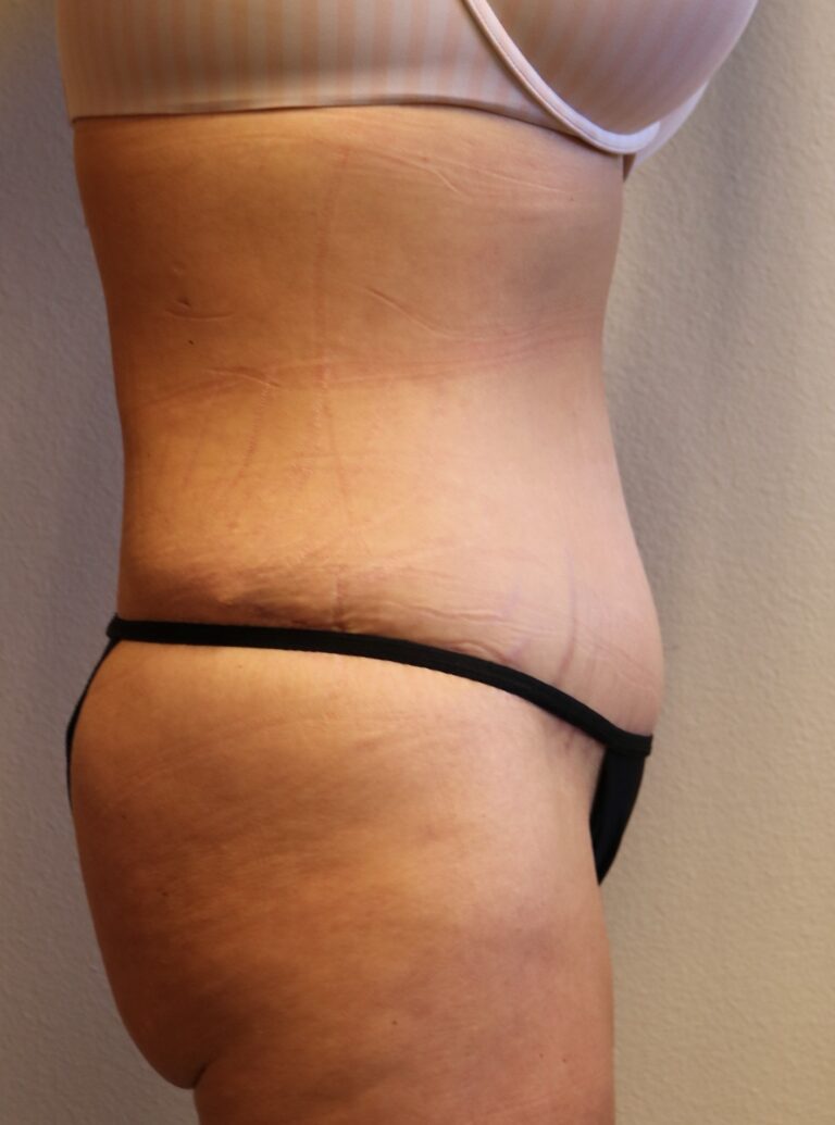 After Image: Tummy Tuck – Fort Worth - right-side