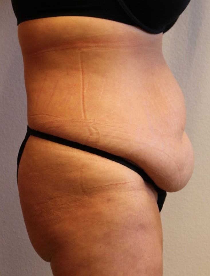 Before Image: Tummy Tuck – Fort Worth - right-side