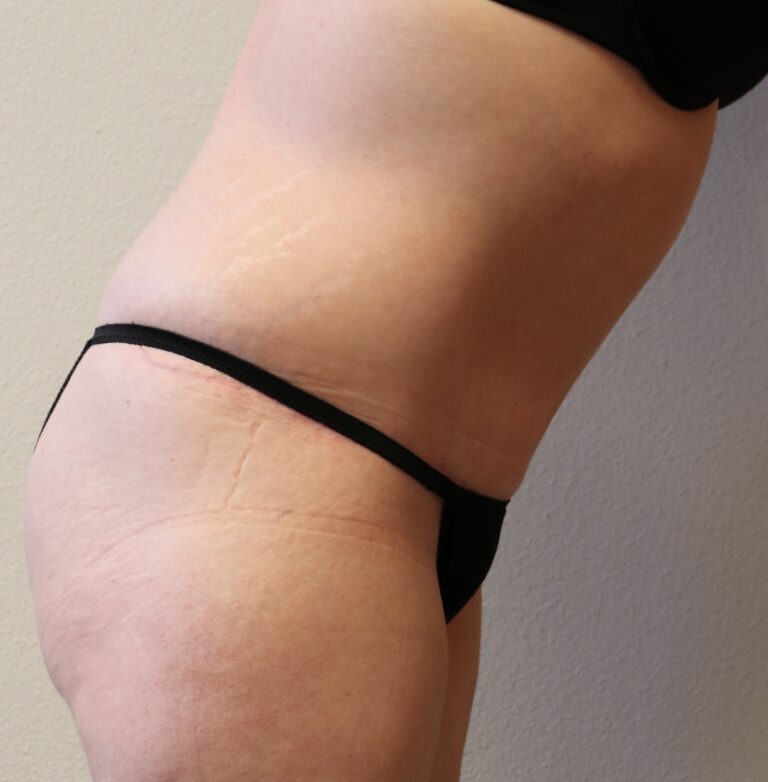 After Image: Tummy Tuck – Fort Worth - other