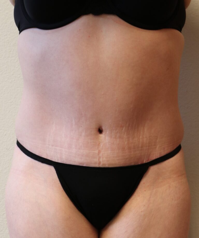 After Image: Tummy Tuck – Fort Worth - front