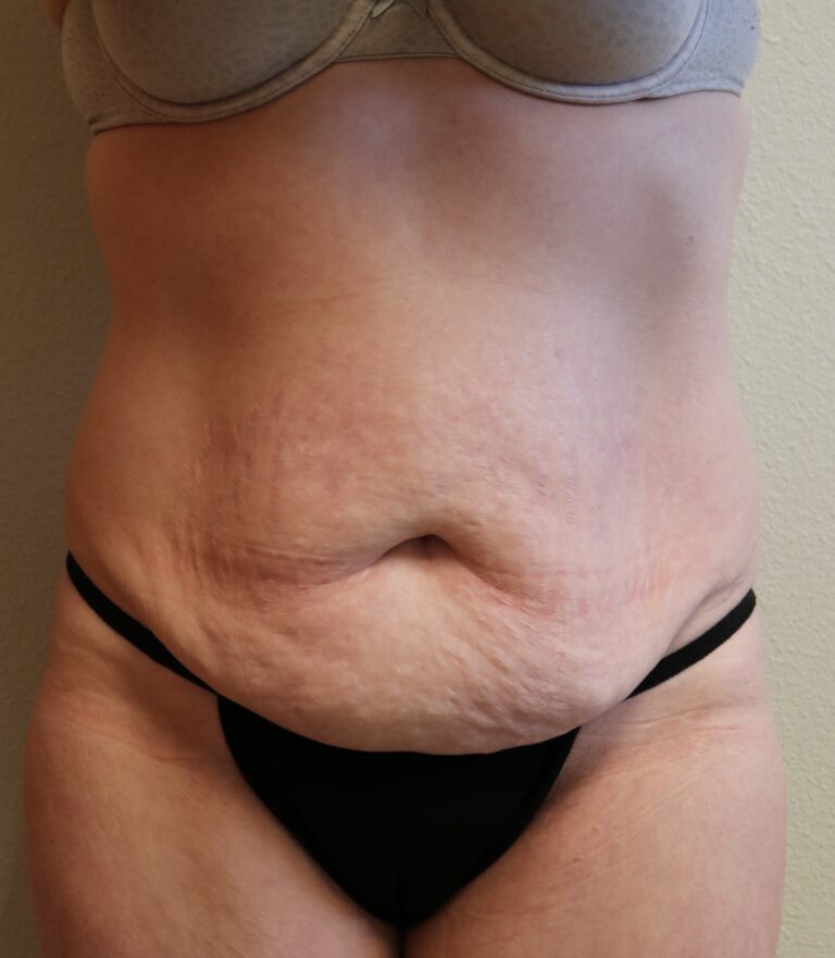 Before Image: Tummy Tuck – Fort Worth - front