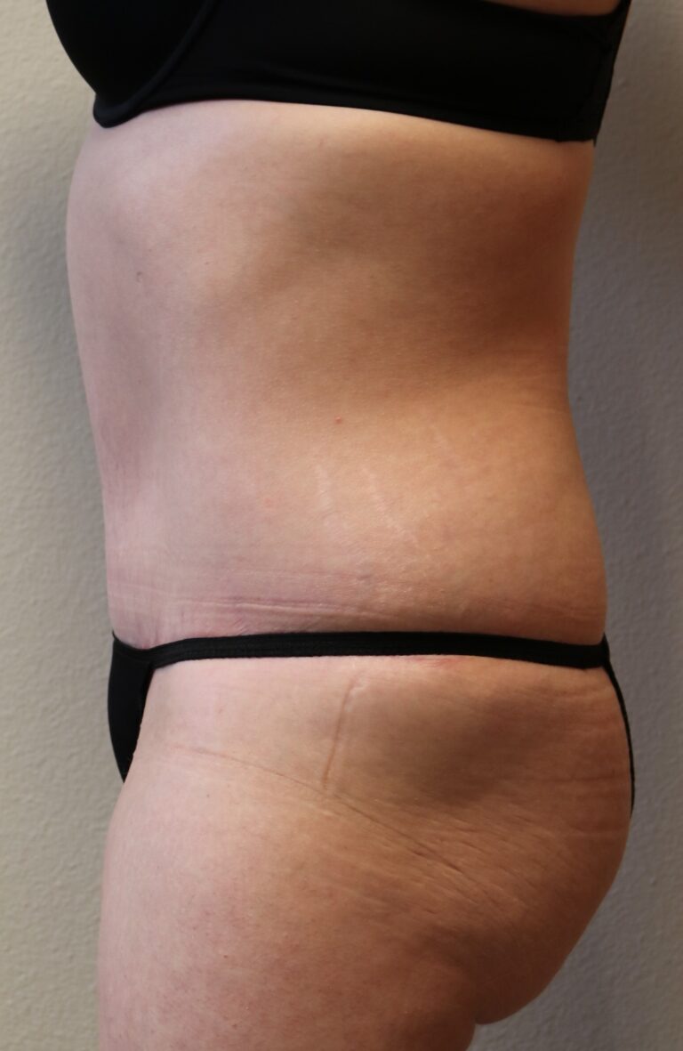 After Image: Tummy Tuck – Fort Worth - left-side