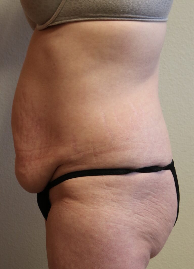 Before Image: Tummy Tuck – Fort Worth - left-side