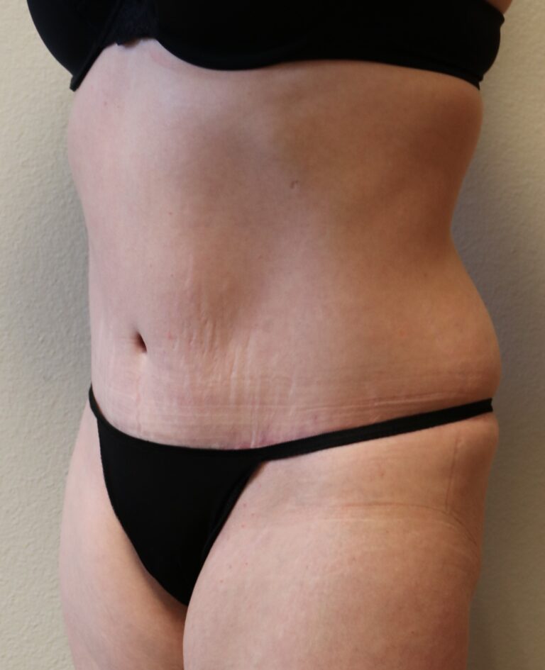 After Image: Tummy Tuck – Fort Worth - left-front-oblique