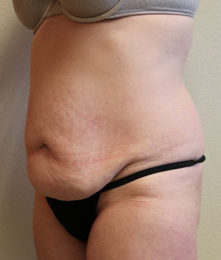 Before Image: Tummy Tuck – Fort Worth - left-front-oblique