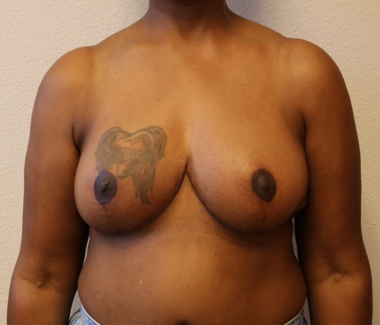 After Image: Breast Reduction – Fort Worth - front