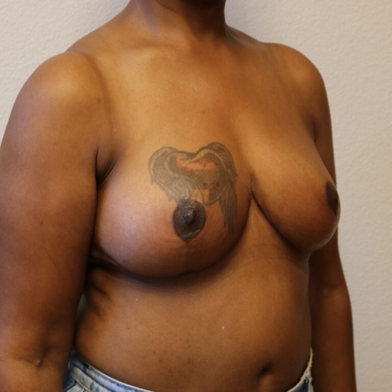 After Image: Breast Reduction – Fort Worth - right-front-oblique