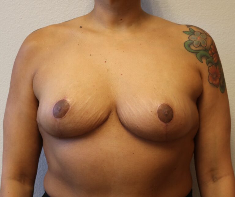After Image: Breast Reduction – Fort Worth - front