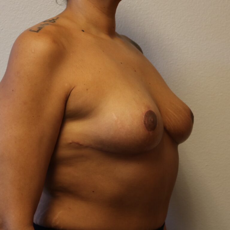 After Image: Breast Reduction – Fort Worth - right-front-oblique