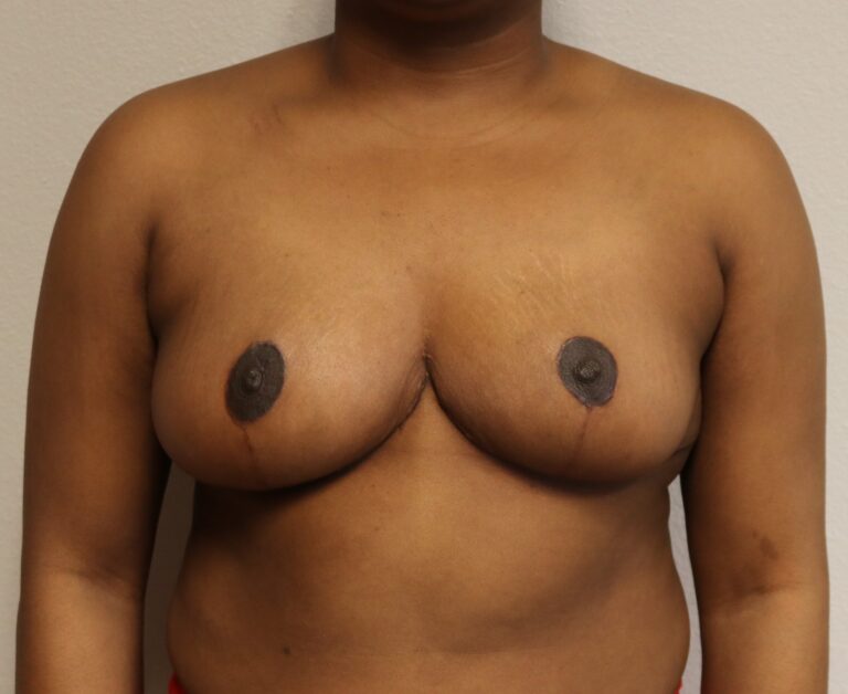After Image: Breast Reduction – Fort Worth - front