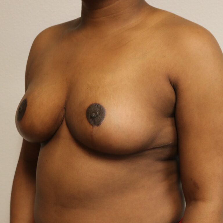 After Image: Breast Reduction – Fort Worth - left-front-oblique