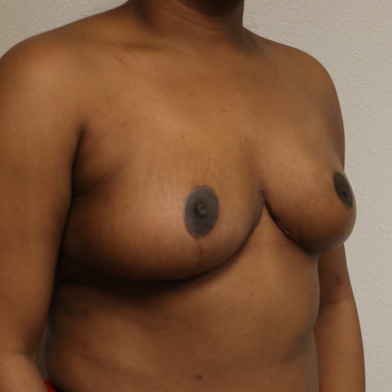 After Image: Breast Reduction – Fort Worth - right-front-oblique