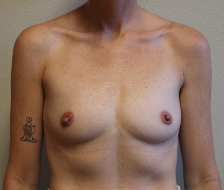 Before Image: Breast Augmentation – Fort Worth - front