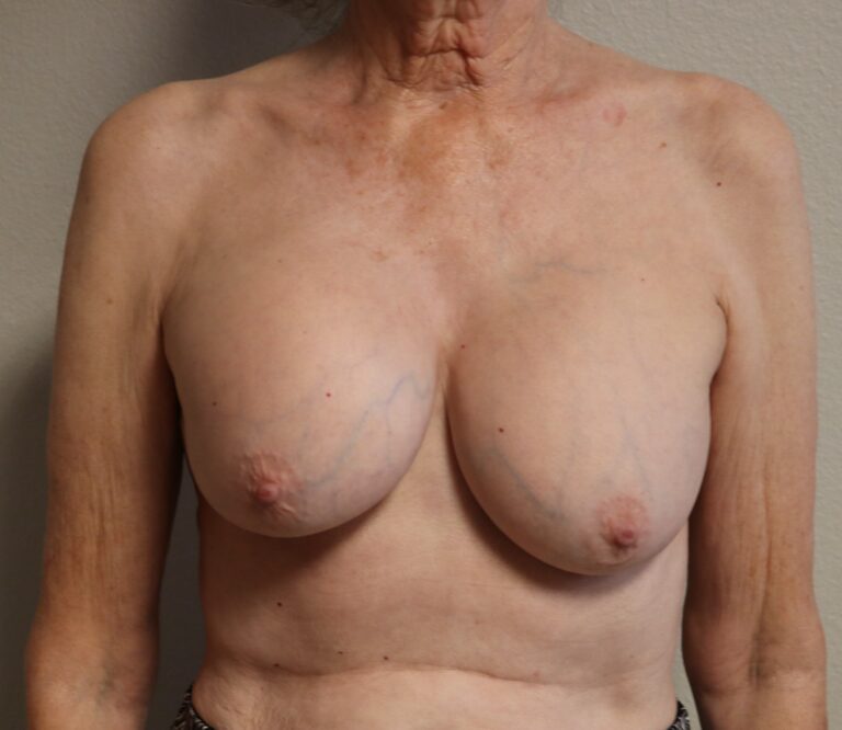 Before Image: Breast Revision – Fort Worth - front