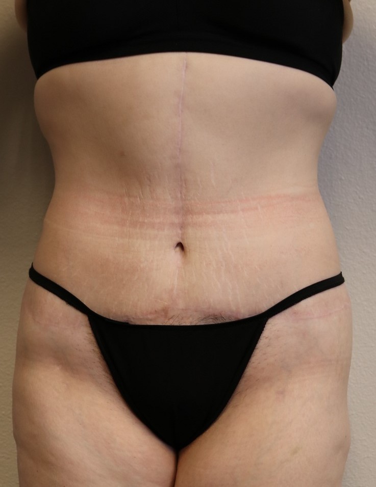 After Image: Lower Body Lift – Fort Worth - front
