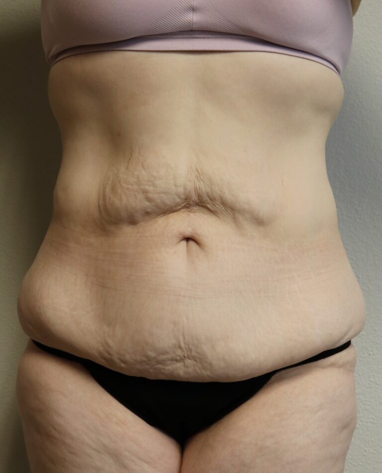 Before Image: Lower Body Lift – Fort Worth - front