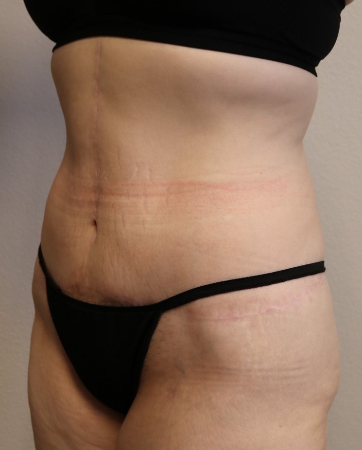 After Image: Lower Body Lift – Fort Worth - left-front-oblique
