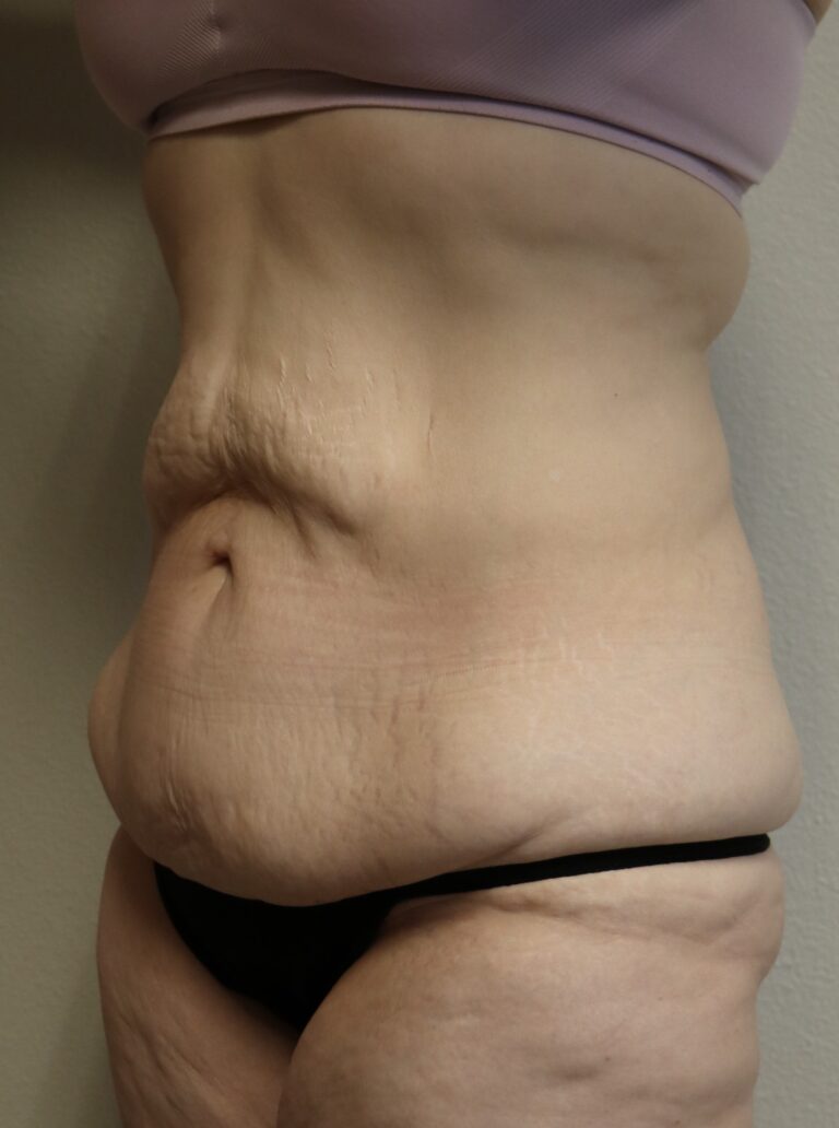 Before Image: Lower Body Lift – Fort Worth - left-front-oblique