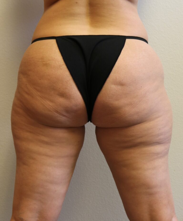 Before Image: Liposuction – Fort Worth - back