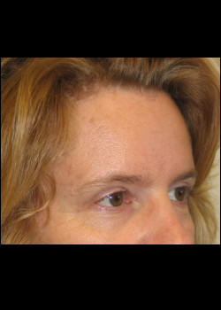 After Image: Brow Lift - other