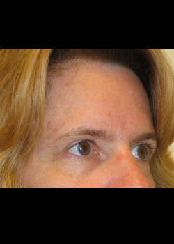 Before Image: Brow Lift - other