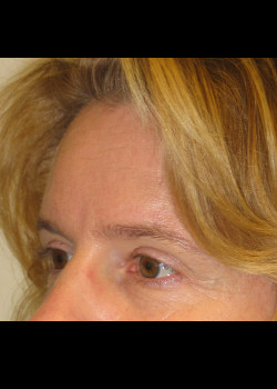 After Image: Brow Lift - other