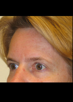 Before Image: Brow Lift - other