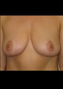 Breast Lift without Augmentation