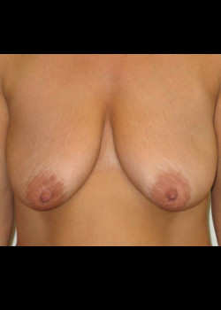 Breast Lift without Augmentation