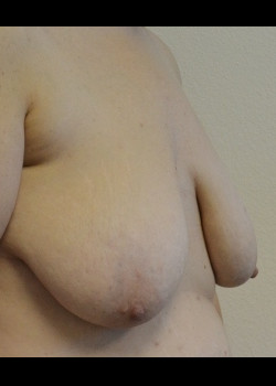 Breast Lift without Augmentation – Case 6