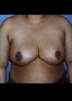 Breast Reduction