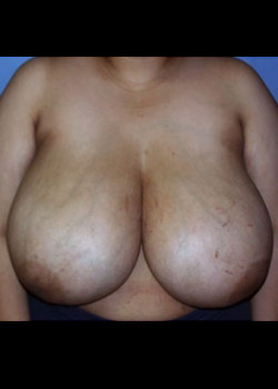 Breast Reduction