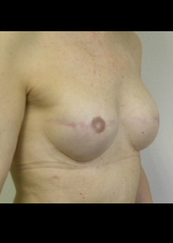 Breast Reconstruction – Case 26