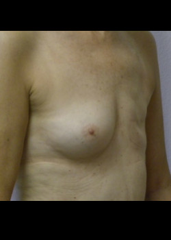 Breast Reconstruction – Case 26