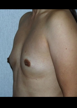 Breast Reconstruction – Case 11