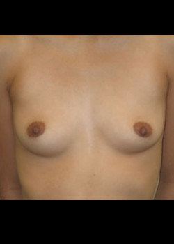 Breast Augmentation