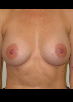 Breast Augmentation