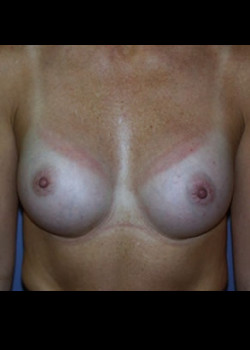 Breast Augmentation