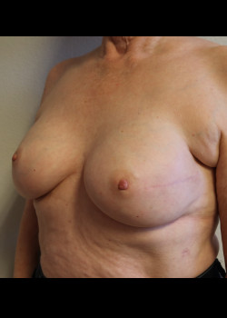 Breast Reconstruction – Case 3