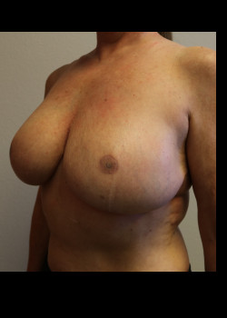 Breast Reconstruction – Case 24
