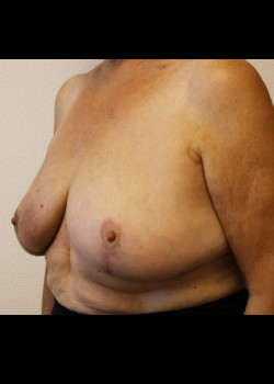 Breast Reconstruction – Case 15