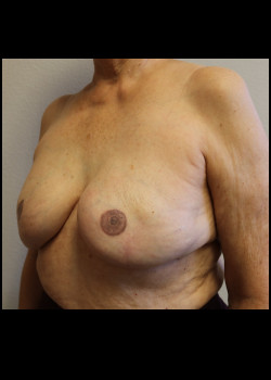 Breast Reconstruction – Case 16
