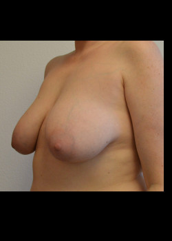 Breast Lift without Augmentation – Case 2