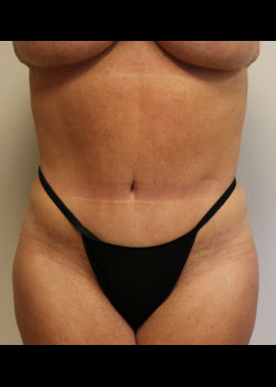 Abdominoplasty